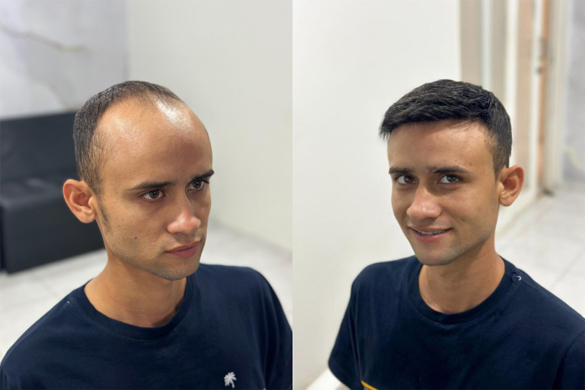 Antes e depois da aplicação da Prótese Capilar