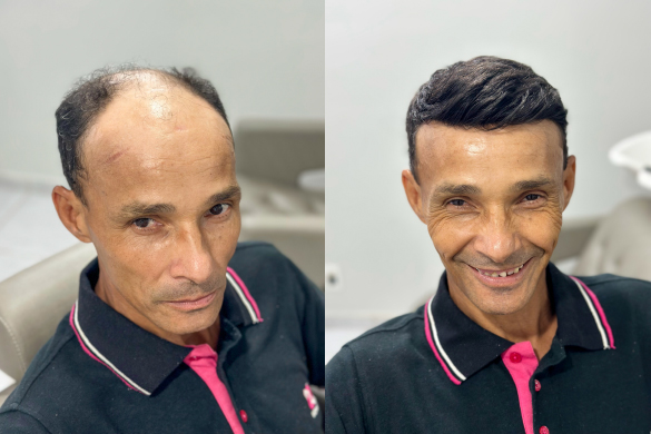 Antes e depois da aplicação da Prótese Capilar