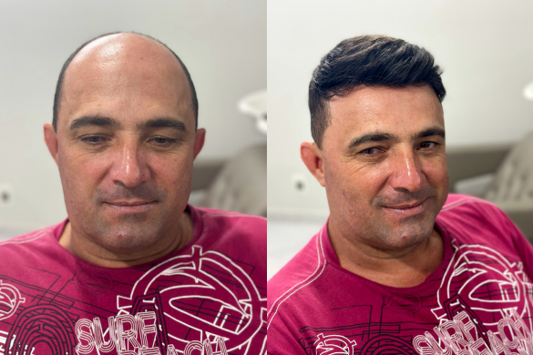Antes e depois da aplicação da Prótese Capilar