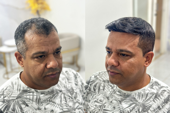 Antes e depois da aplicação da Prótese Capilar