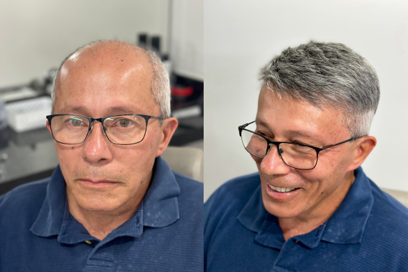 Antes e depois da aplicação da Prótese Capilar