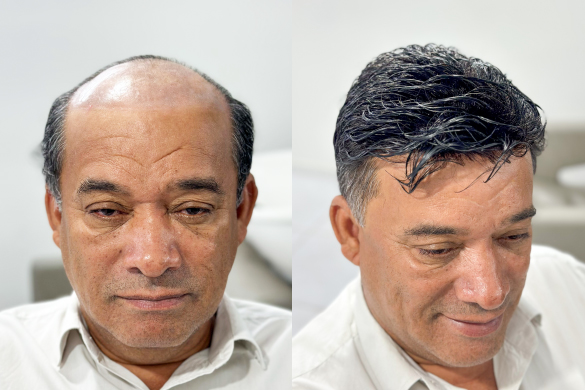 Antes e depois da aplicação da Prótese Capilar