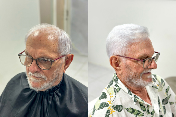 Antes e depois da aplicação da Prótese Capilar